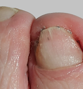 ToeFX phototherapy result 3 — after