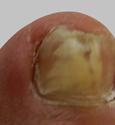 ToeFX phototherapy result 2 — before