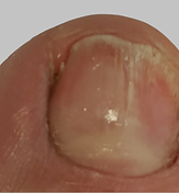 ToeFX phototherapy result 2 — after