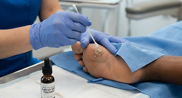 wart treatment close-up