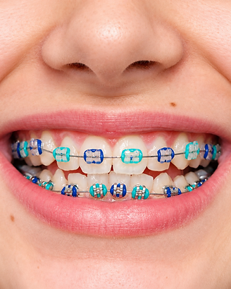 Braces at Caldas Orthodontics in Weston, FL