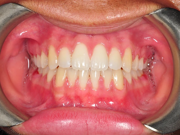 Bite Correction