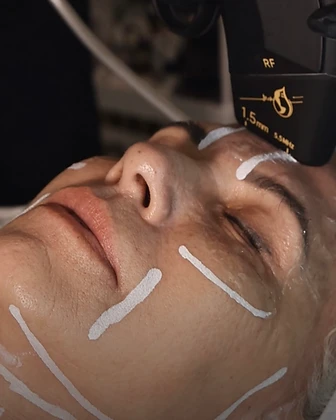 HIFU treatment being applied to a client's face