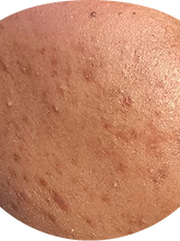 Blemishes & Acne marks