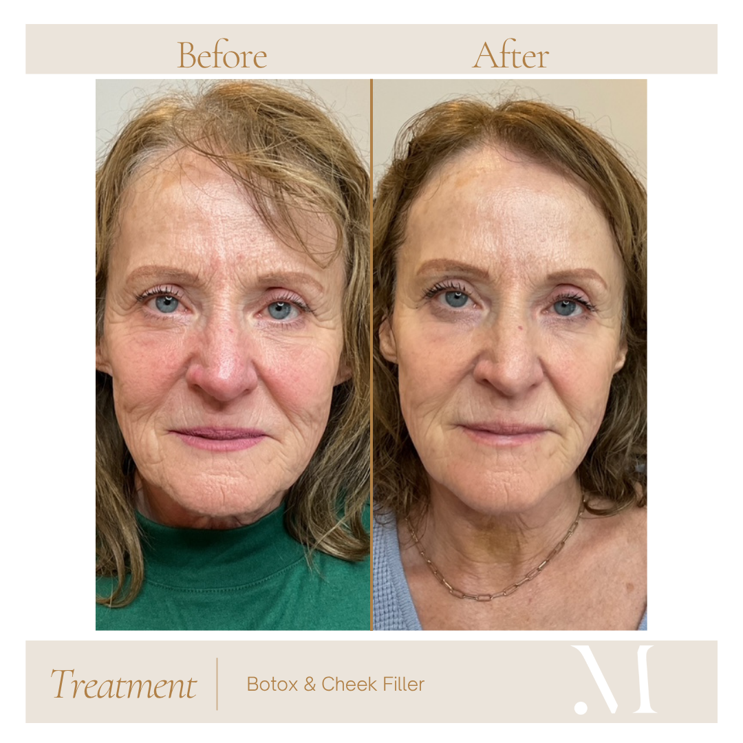Before and after Botox and cheek filler