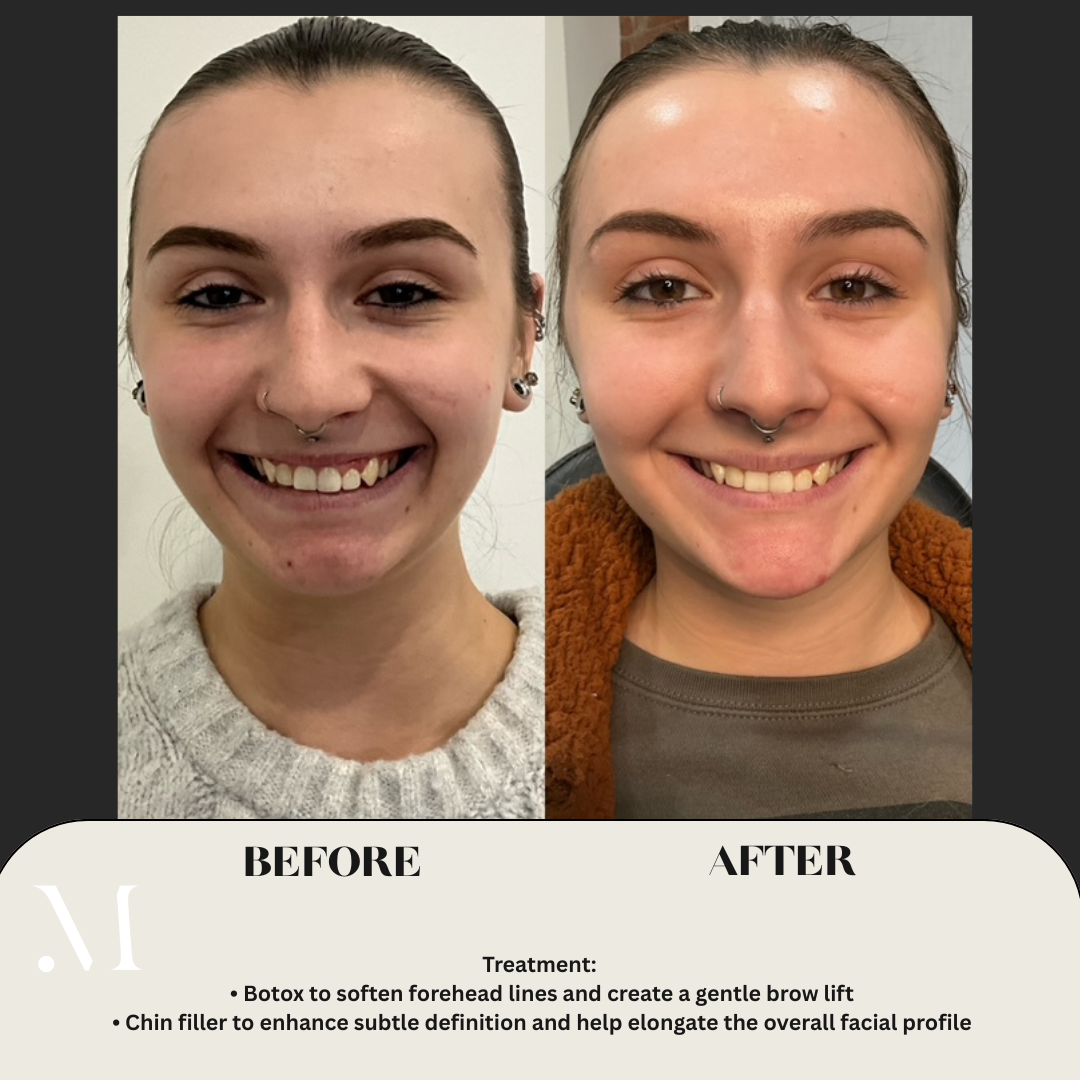 Before and after Botox and chin filler