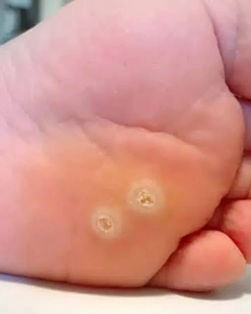 Clinical reference for Lesion Removal