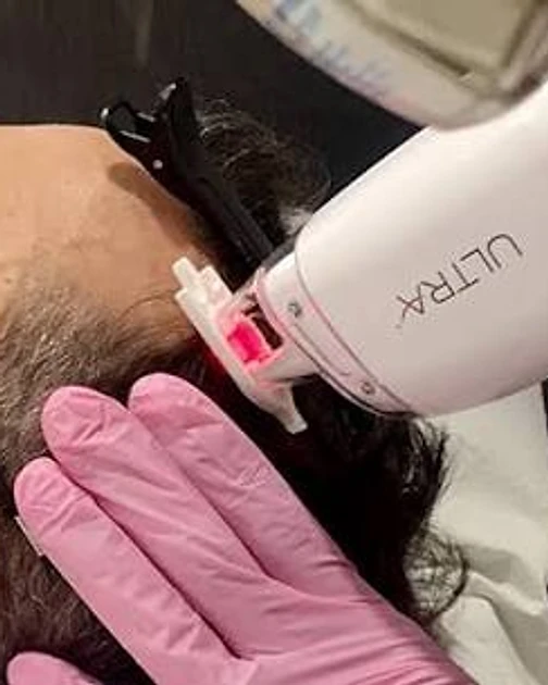 Lutronic ULTRA 1927 hair restoration treatment on the scalp