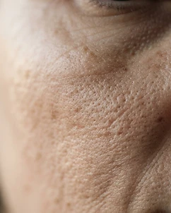 Renew — Correct texture + stimulate collagen