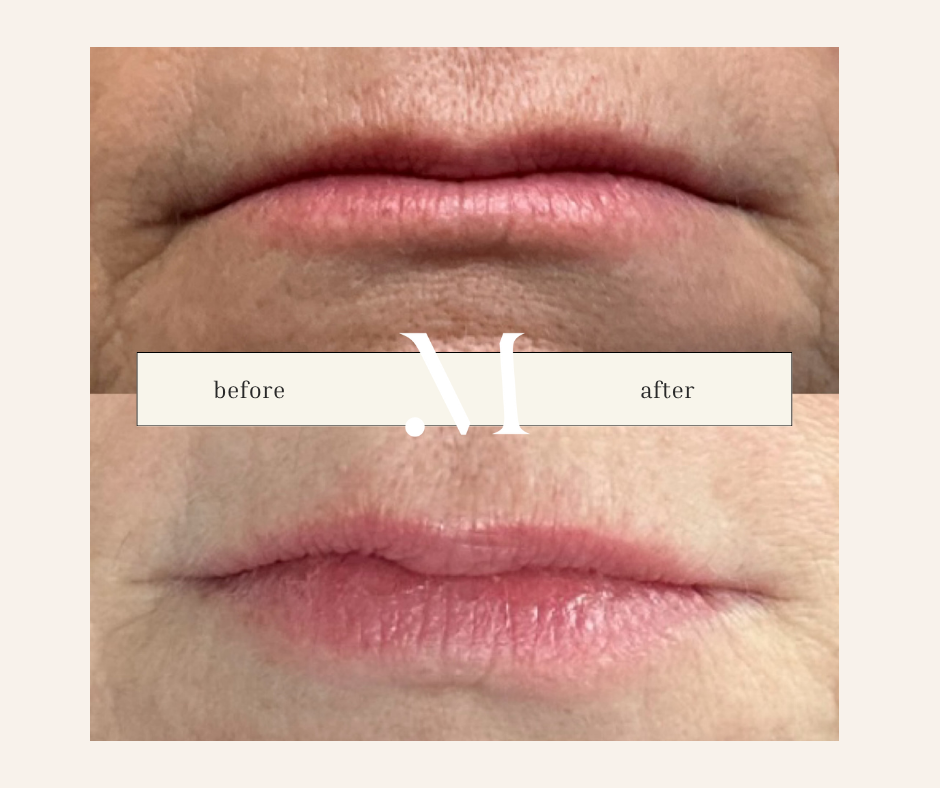 Before and after lip flip