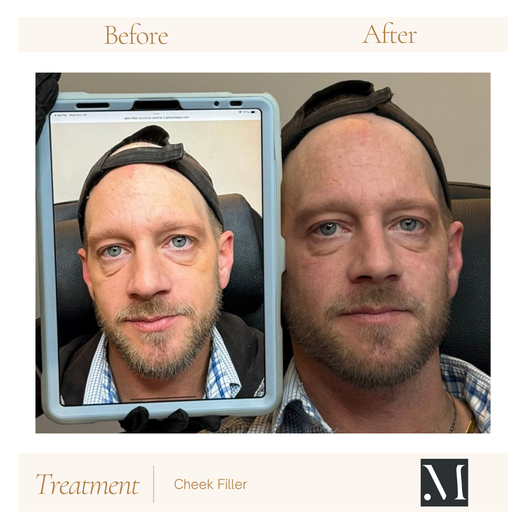 Before and after cheek filler