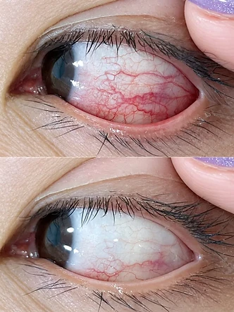 Eye SPA Rehabilitation beauty work by SW Beauty — Eye area treatment — before & after