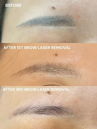 Brows beauty work by SW Beauty — Brow laser removal — before, after the 1st session and after the 3rd.