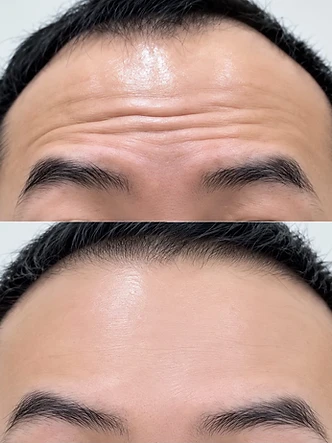 Aesthetic beauty work by SW Beauty — Forehead wrinkle treatment — before & after