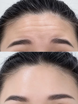 Aesthetic beauty work by SW Beauty — Forehead wrinkle treatment — before & after