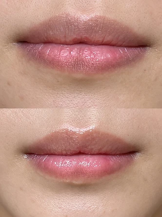 Lips beauty work by SW Beauty — Pink lip laser — before & after