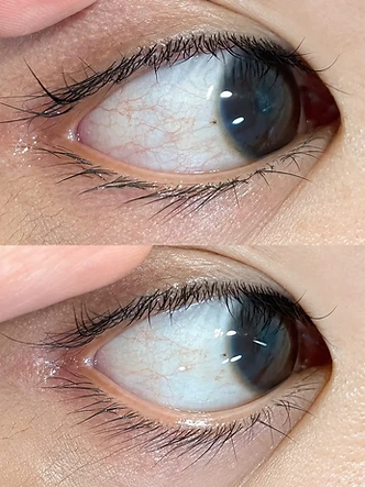 Eye SPA Rehabilitation beauty work by SW Beauty — Eye area treatment — before & after