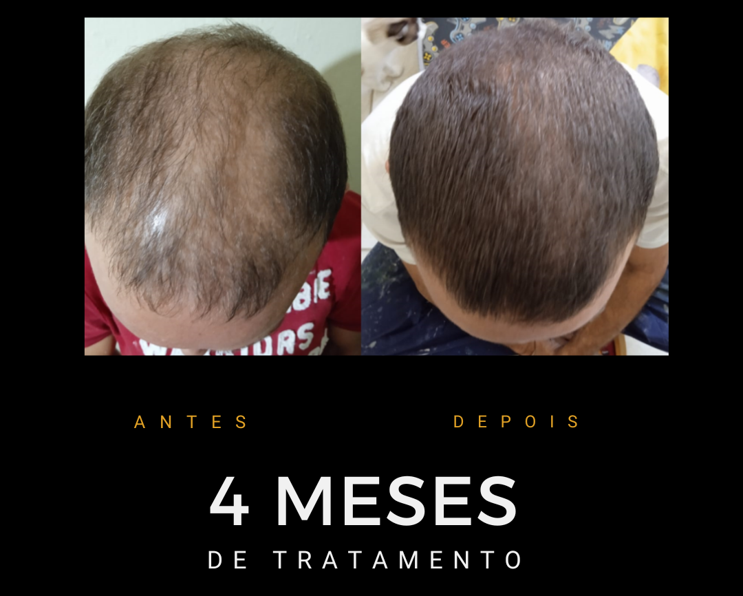 Antes e depois do protocolo