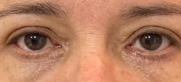 Blefaroplastia — Caso 2, depois