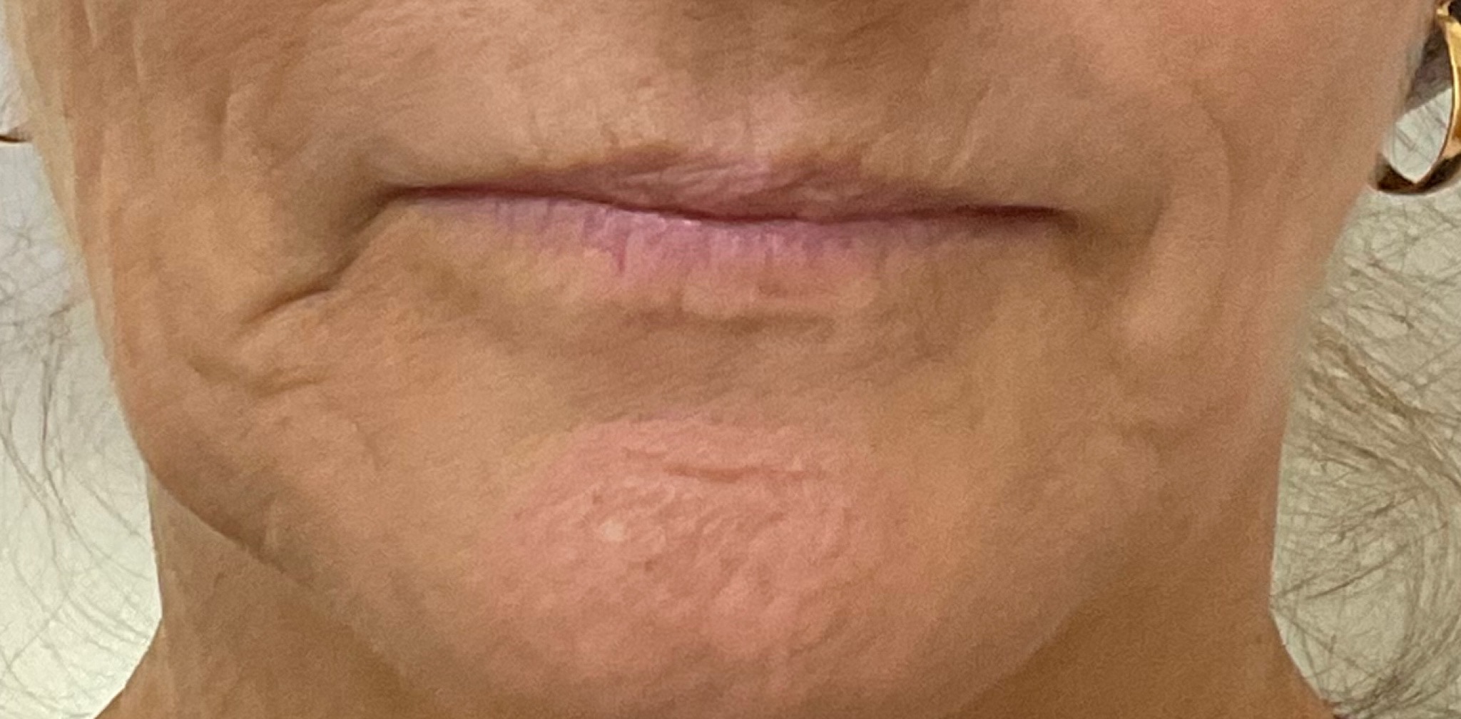 Região perioral, antes