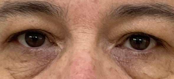 Blefaroplastia — Caso 2, antes