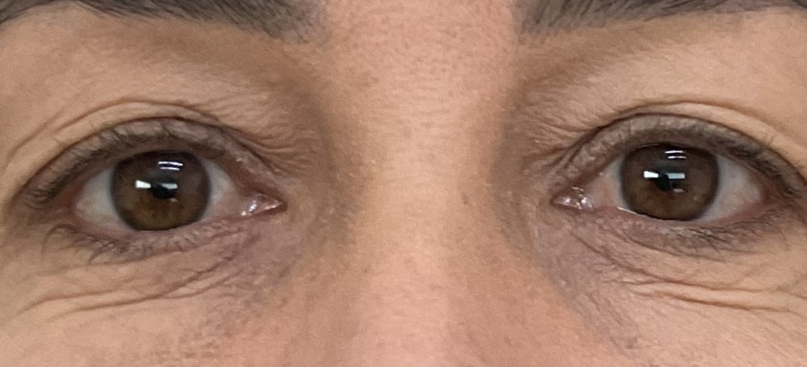 Blefaroplastia — Caso 1, antes
