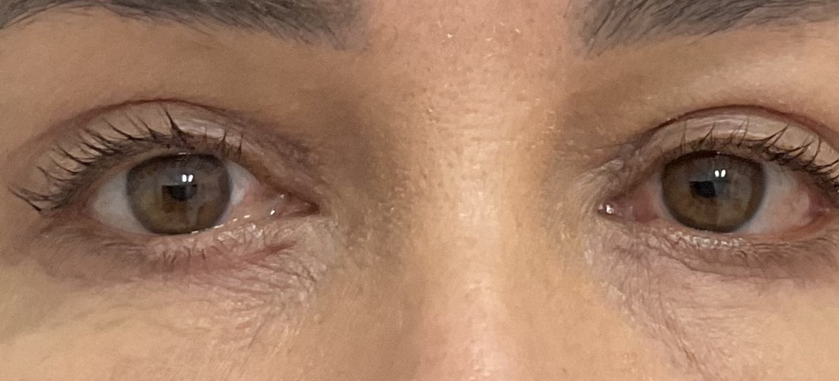 Blefaroplastia — Caso 1, depois