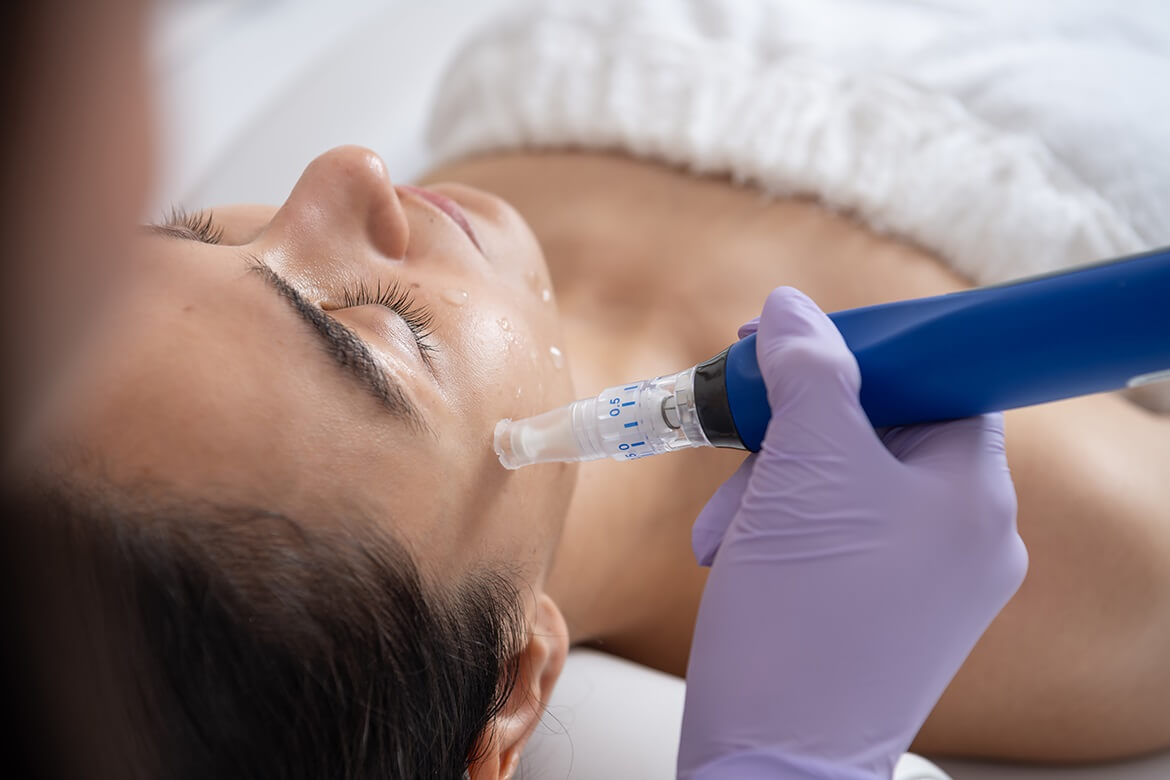 Professional microneedling treatment with PDRN at Anavaya