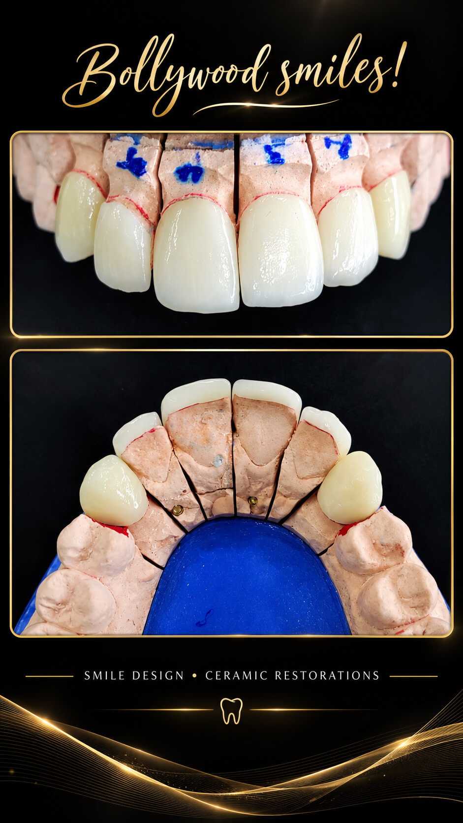 Before and after Smile Design — Ceramic Restorations