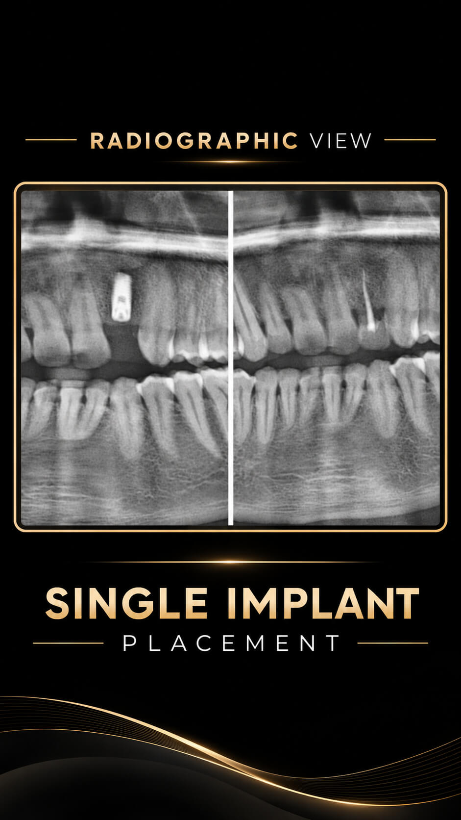 Before and after Single Implant — Radiographic View