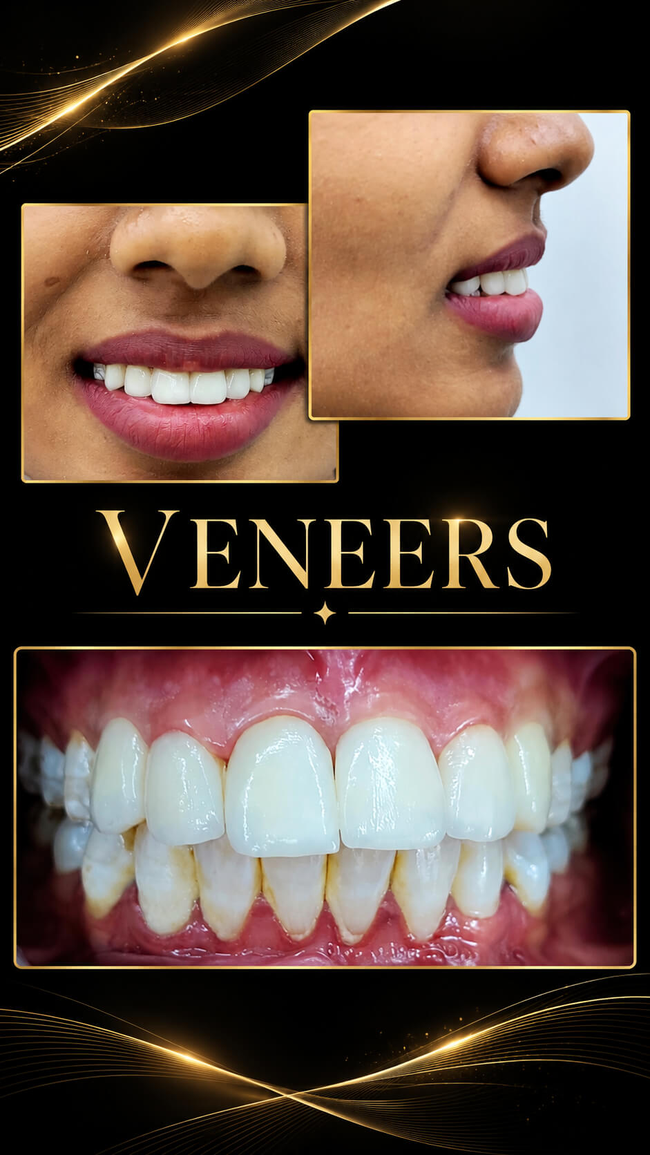 Before and after Veneers — Smile Showcase