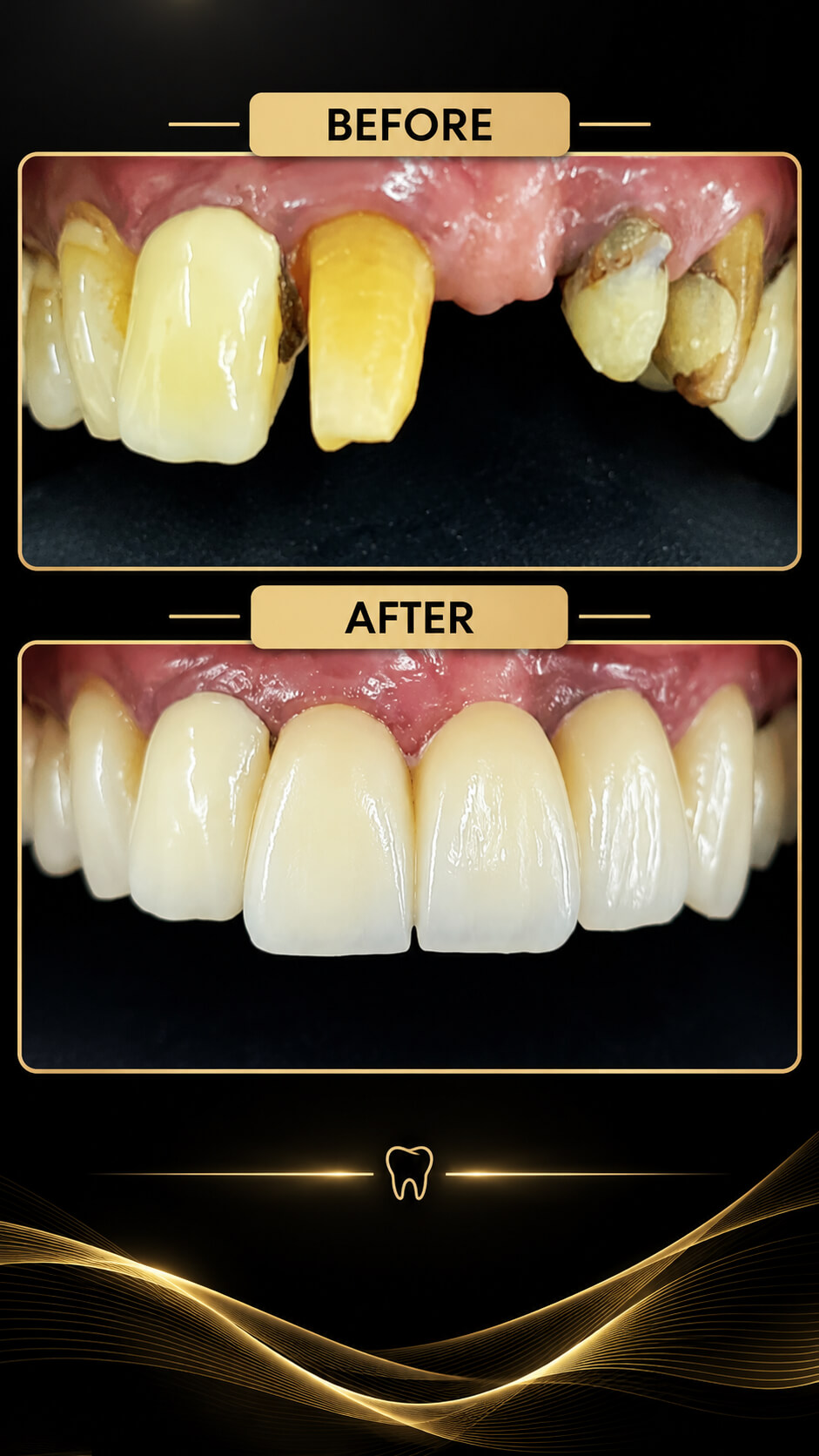 Before and after Smile Makeover — Before & After