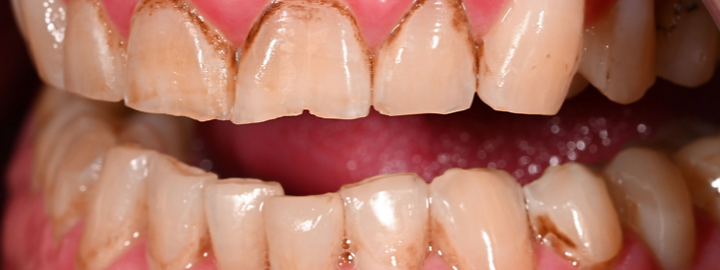 Cosmetic smile transformation, before