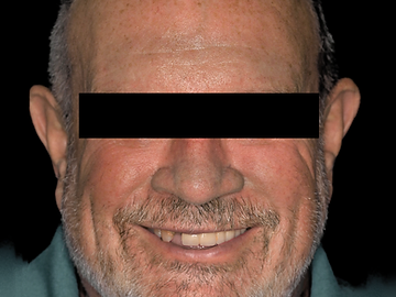 Full-arch implant restoration, before
