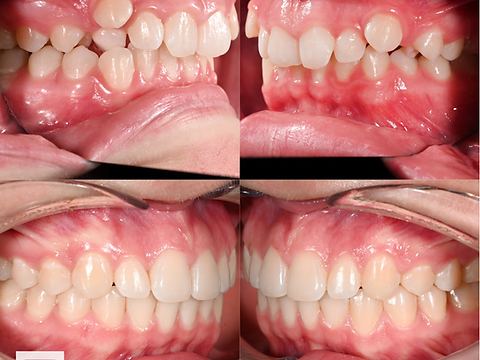 Right and left buccal views before and after orthodontic alignment