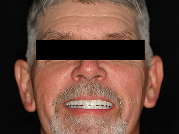 Full-arch implant restoration, after