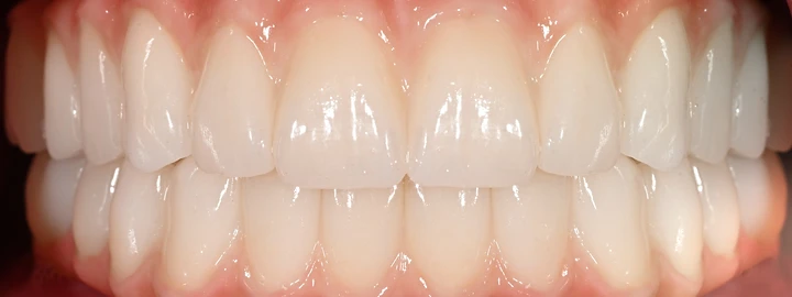 Upper and Lower Zirconia Full Arch, after