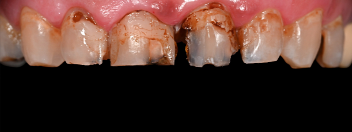 Cosmetic smile transformation, before
