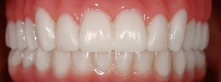 Upper Snap in Denture, Lower PMMA Full Arch, after