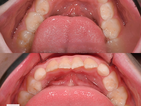 Lower occlusal view before and after alignment