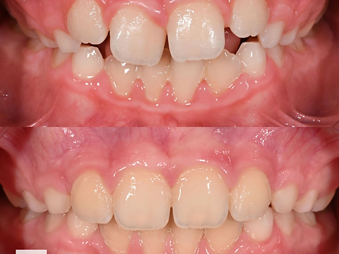 Frontal view before and after orthodontic alignment