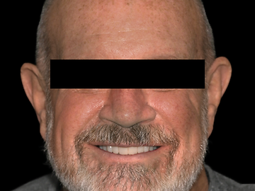 Full-arch implant restoration, after