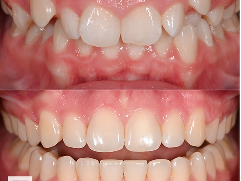 Front view before and after orthodontic alignment
