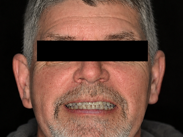 Full-arch implant restoration, before