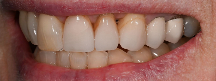Cosmetic smile transformation, before