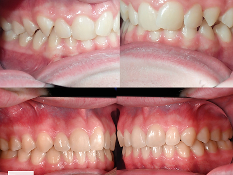 Lateral views before and after orthodontic alignment