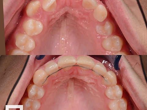 Occlusal view before and after arch development with lingual retainer
