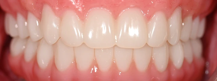 Upper Snap in Denture, Lower PMMA Full Arch, after