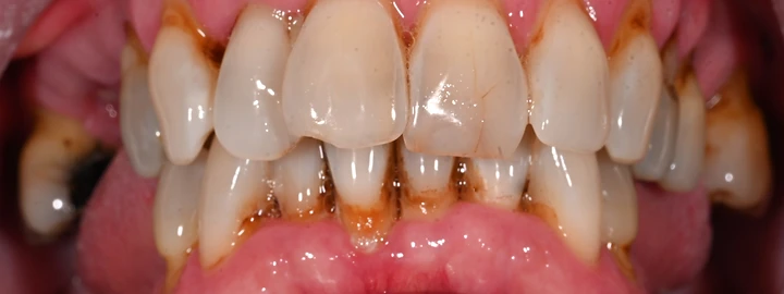 Upper and Lower Zirconia Full Arch, before