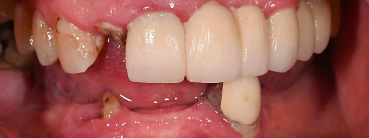Upper and Lower Zirconia Full Arch, before